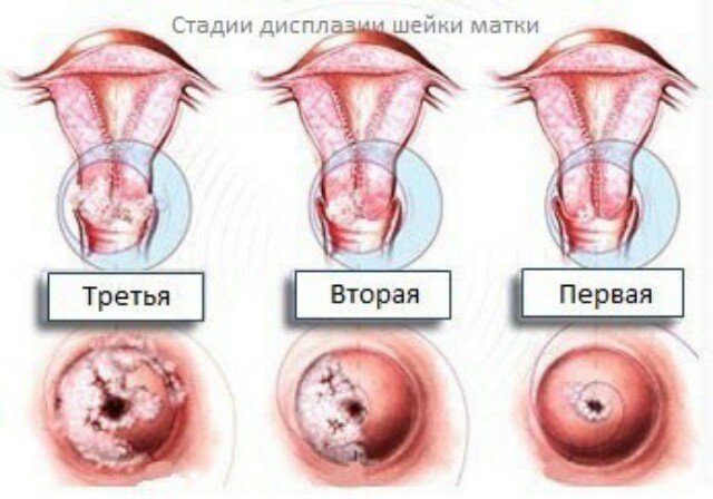 Лечение дисплазии тазобедренных суставов в СПб
